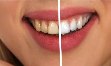 Evde Diş Beyazlatma Yöntemleri